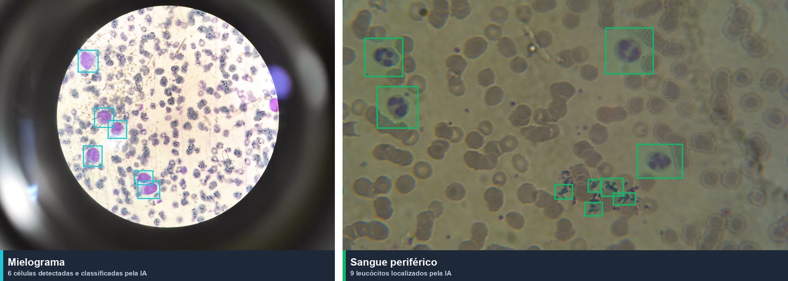 AI detections in bone marrow and peripheral blood